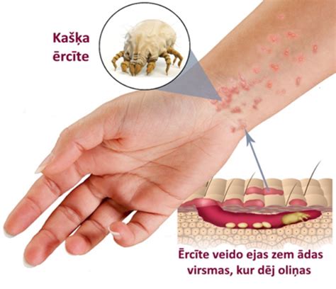 kašķis bildes|Kašķis: kas ir kašķis, kā atpazīt tā simptomus un kā。